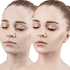 Cosmelan Treatment